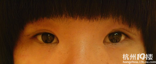 22号割双眼皮归来,记录恢复过程-美容护肤-杭州