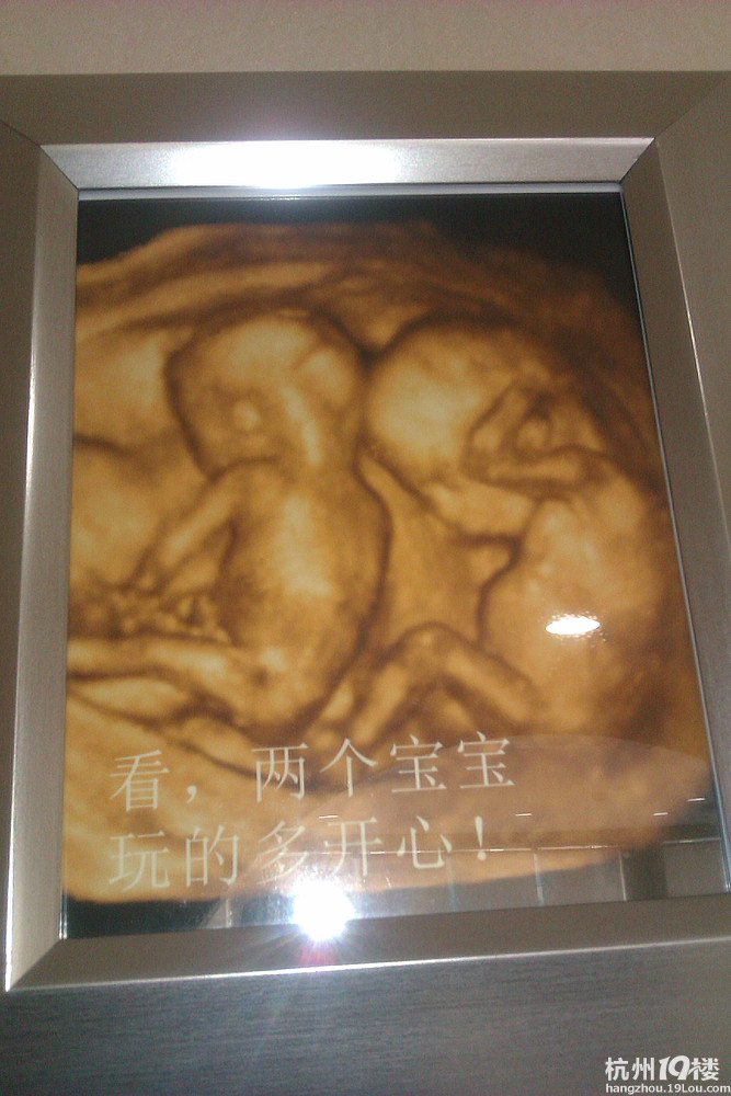 双胞胎可以到浙江优你可妇科医院做三维四维彩