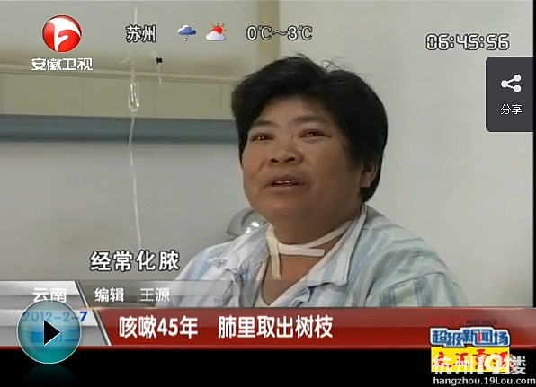 <em>妇女咳嗽</em>45年 竟从肺里取出7厘米树枝-公社之