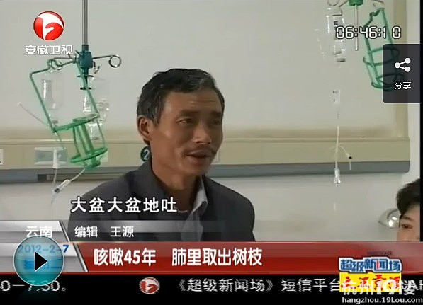<em>妇女咳嗽</em>45年 竟从肺里取出7厘米树枝-公社之