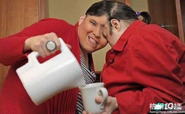 连体婴儿也能健康成长,看看他们长大后的样子吧-健康杂谈-健康之家-杭州19楼