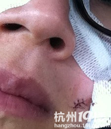 手术去黑痣 全过程 后面 会上 拆线的照片-网上