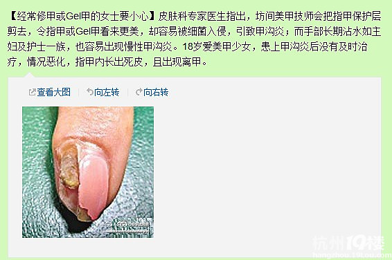 这新闻太可怕了!<em>18岁少女</em>爱美甲,导致手指腐烂