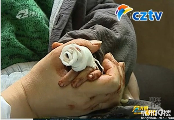 兔子急了真会咬人 11个月宝宝手指被咬断了-孩