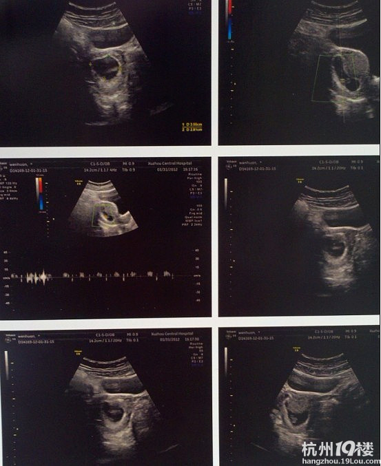 彩超和<em>唐氏</em>筛查能看<em>男女</em>吗?专业人士来帮我看