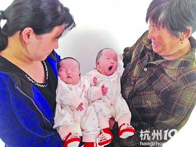 醫(yī)院為連體姐妹成功分身(組圖)