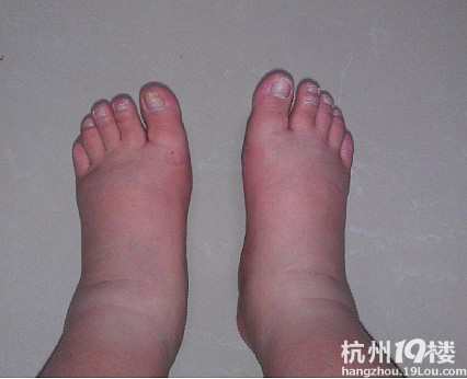 孕38周,肿的跟猪蹄一样的双脚-准妈妈论坛-杭州