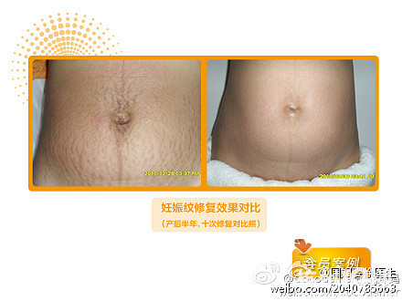 怀孕7个月长妊娠纹了怎么办-孕晚期(29-40周)