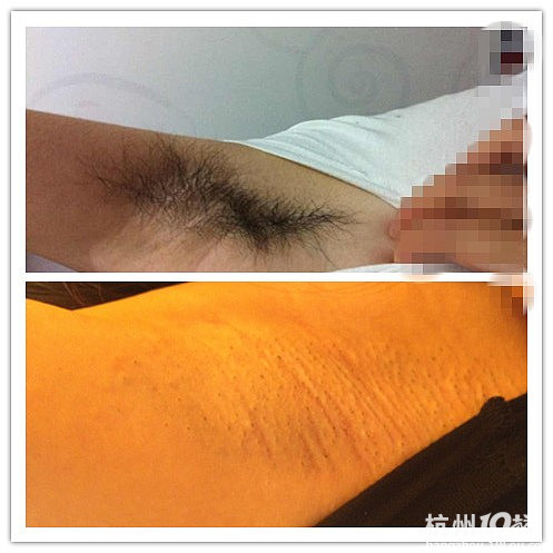 维多利亚脱腋毛-整形美体-<em>女性</em>健康-杭州<em>19楼</em>