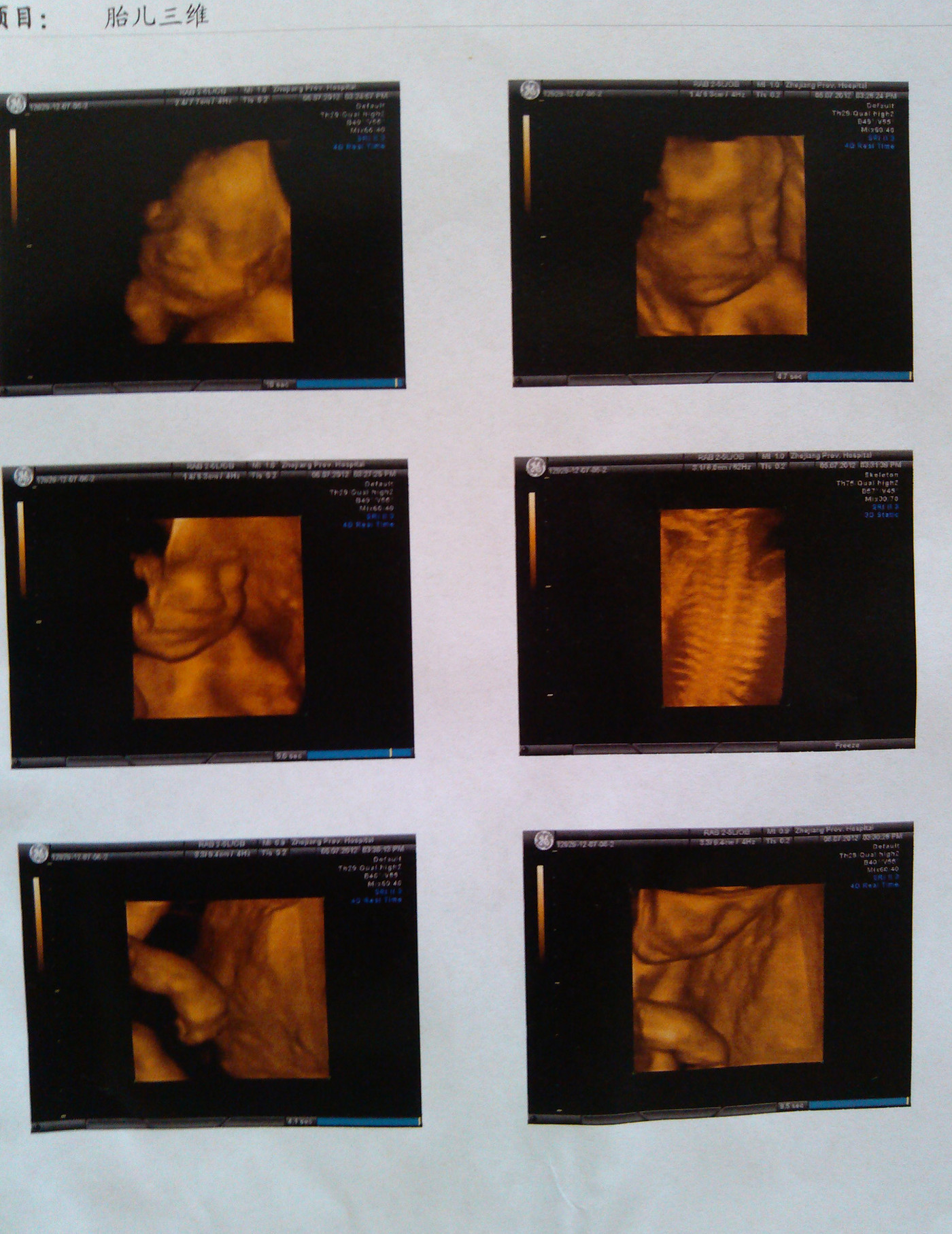 25+2省人民医院做的三维b超