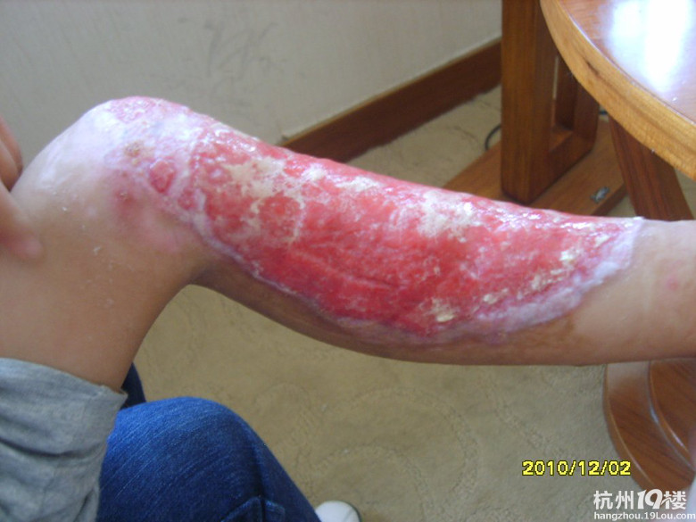 为全国<em>烧伤烫伤</em>小孩子免费治疗-商家自荐区-余