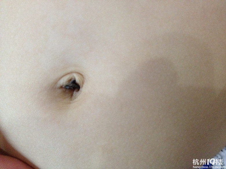 13个月大宝宝肚脐部分有黑黑硬硬的东西,向医