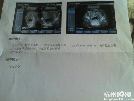 怀孕2个月,宝宝检查很好,呵呵!-准妈妈论坛-杭州
