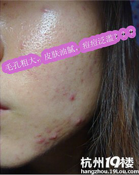 在线咨询--痘痘、激素性皮炎、激素痘-问题肌肤