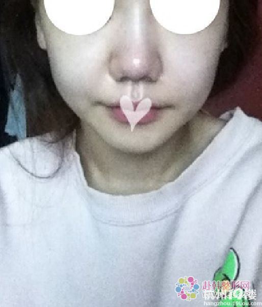 方下巴手术和颧骨缩小术2个月后-案例分享-整