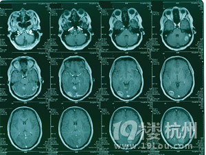 颅内多发转移瘤射波刀怎么治-网上问医-杭州1
