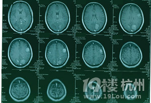 颅内多发转移瘤射波刀怎么治-网上问医-杭州1
