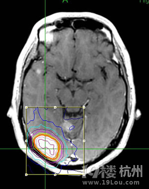 颅内多发转移瘤射波刀怎么治-网上问医-杭州1