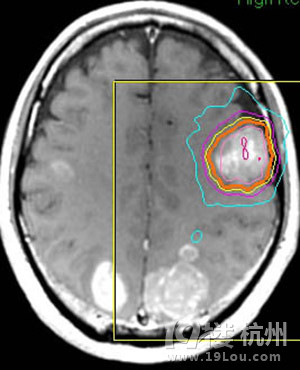 颅内多发转移瘤射波刀怎么治-网上问医-杭州1