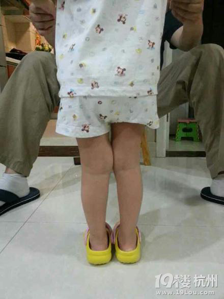 宝宝有点X型腿。求助-幼儿期(1-3岁)-孩爸孩妈