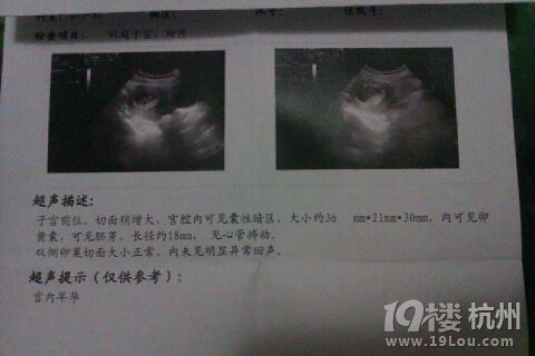怀孕两月做的B超能看出是男宝或女宝嘛?-孕早