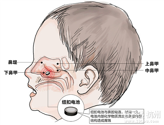 3歲男孩的鼻孔里，塞了顆紐扣電池