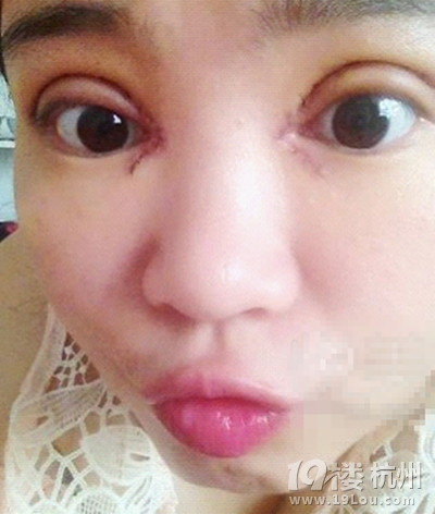 割双眼皮:做了七天了~记录我的双眼皮过程-案