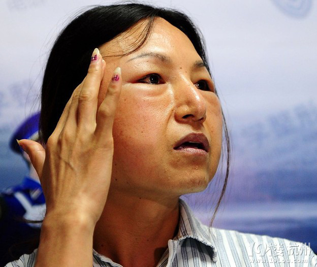 广州一<em>打工妹</em>小诊所丰脸失败变畸形-潮流动