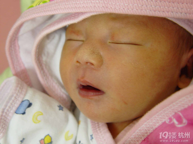 宝宝脸上有白斑,爸妈别急慢慢治-婴儿期(1-12个