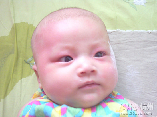 婴儿奶粉过敏是什么?-婴儿期(1-12个月)-孩爸孩