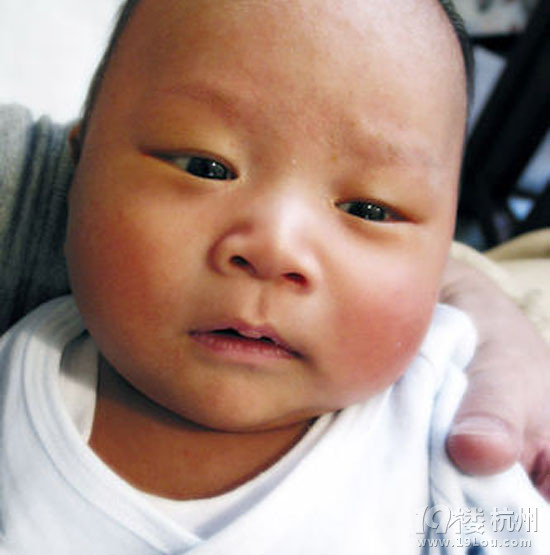 新生儿黄疸治疗方法-婴儿期(1-12个月)-孩爸孩