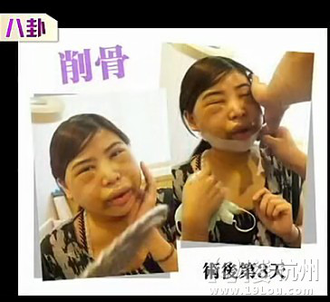 台湾女子曝削骨整容前后对比全过程 触目惊心