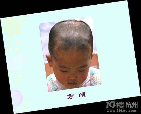 小兒缺鈣的癥狀  