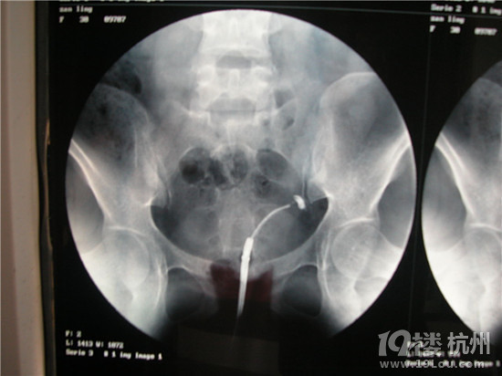 输卵管堵塞会排卵吗?-家事百科-孩爸孩妈聊天