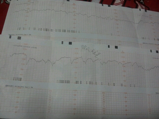 胎心监护不好,吸氧!-准妈妈论坛-杭州19楼