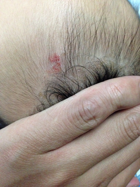 去上海九院给宝宝看血管瘤，如何挂号方便?-婴儿期(1-12个月)-孩爸孩妈聊天室-杭州19楼