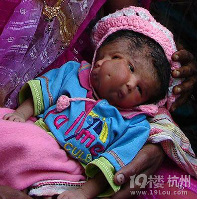 印度诞生罕见双头女婴 第二头颅长在肚子上(图