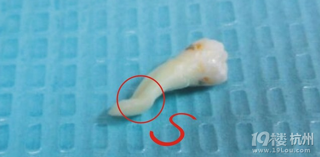 杭州拔智齿哪里好?