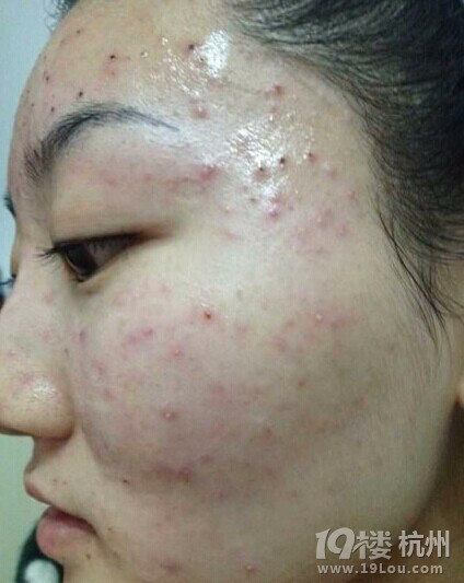 没有免费祛痘,但绝对是19楼最专业的个案疑难痘、激素痘咨询贴-第3页-问题肌肤-美容护肤-杭州19楼