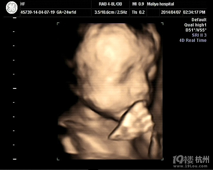 杭州医院做4维彩超真垃圾,非常模糊