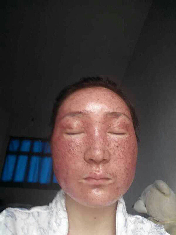 去做雀斑了,敷上面膜后的样子。-美容护肤-杭州