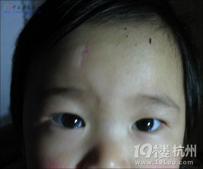 求去疤方法,孩子头上磕了还留下疤痕-学龄期(4
