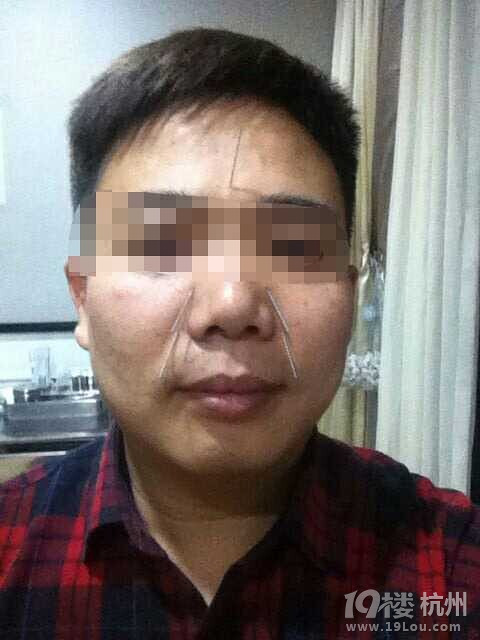 大家有没有试过针灸治疗鼻炎的?