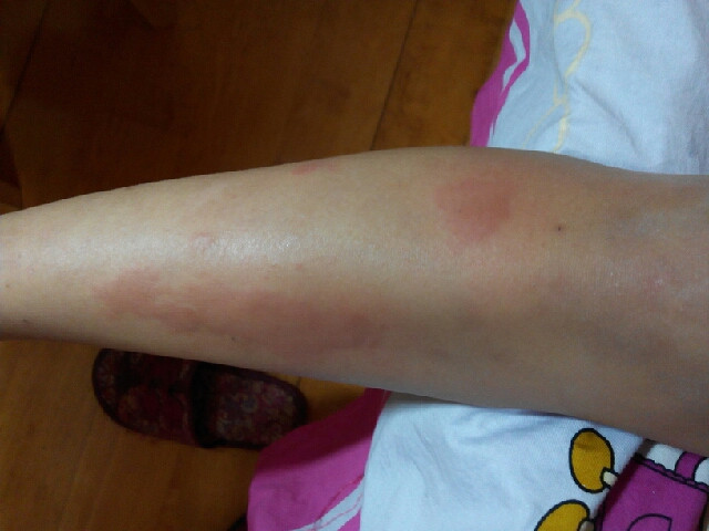 求荨麻疹土方或帮忙推荐良医