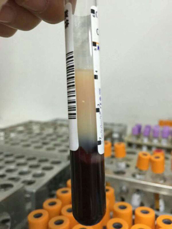 看看这管血标本里的血,血的上面这层乳白的-健