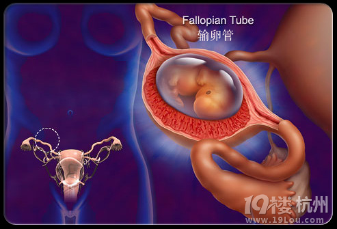 宫外孕有什么反应?这个要注意啊!-孕早期(1-12