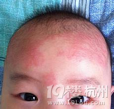 湿疹用什么药?患了湿疹要注意什么?-健康之家