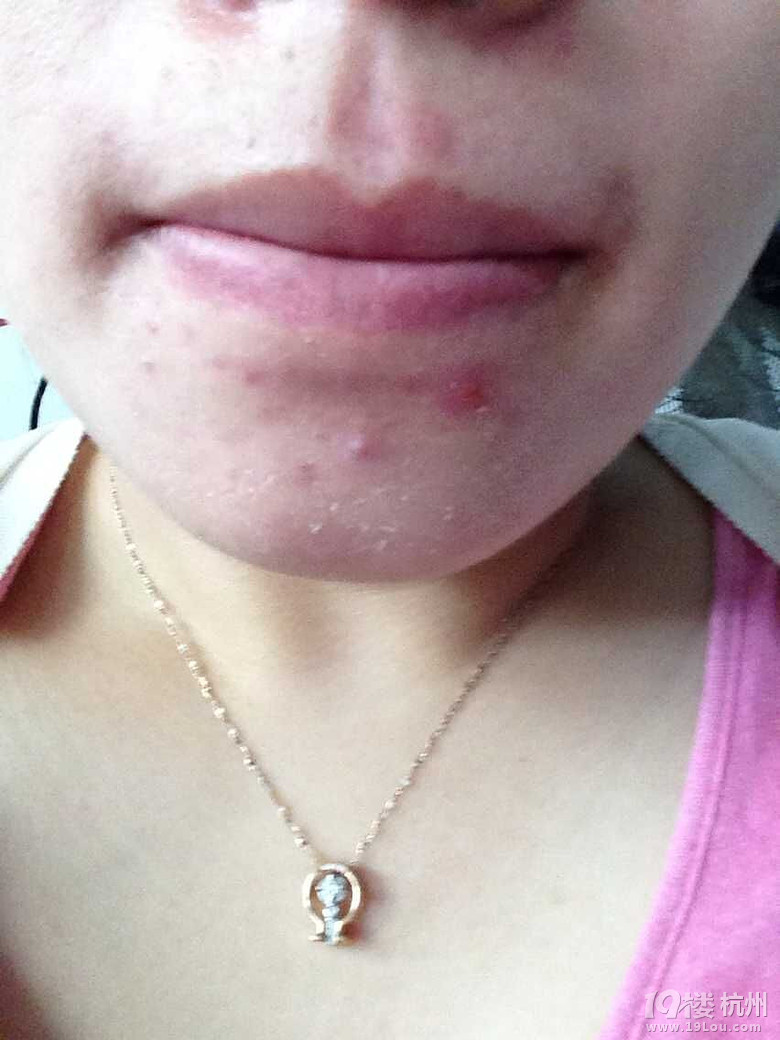 杭州哪里看痤疮痘痘比较好-皮肤病-网上问医-杭