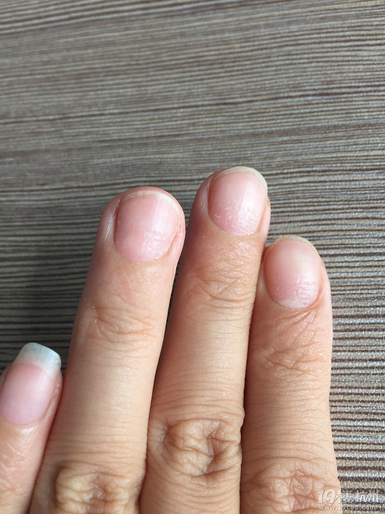 手指甲变成这样是缺什么营养吗?