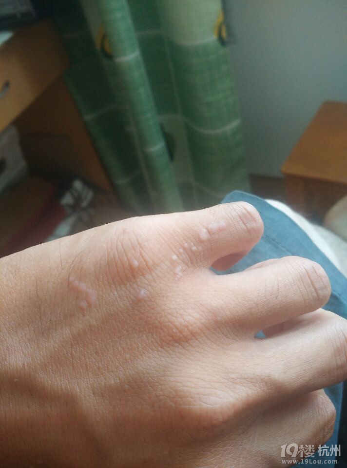 长了扁平疣 求教好心人有没有好方法